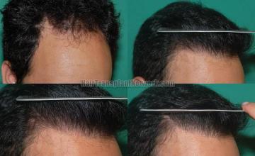 Hair transplantation surgery before and after photos