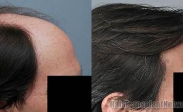 Hair transplantation surgery before and after photos