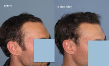 Hair restoration procedure before and after results