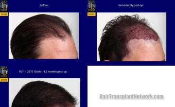 Hair transplantation surgery before and after images