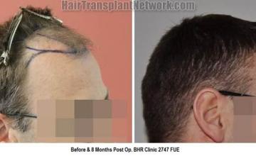 Hair transplantation surgery before and after pictures