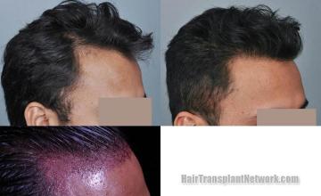 Hair restoration procedure before and after results