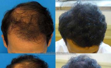 Top view before and after hair restoration results