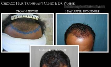 Hair restoration procedure before and after results