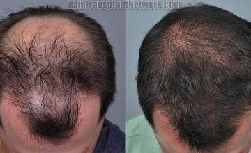 Hair transplantation surgery before and after photos