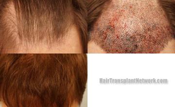 Top view before and after hair restoration results