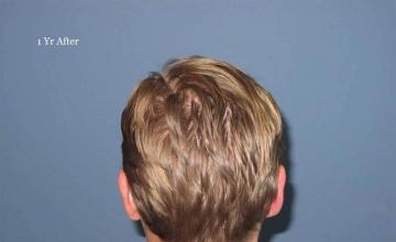 Hair transplant surgery after photo 