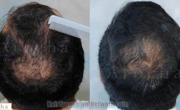 Hair transplantation surgery before and after images