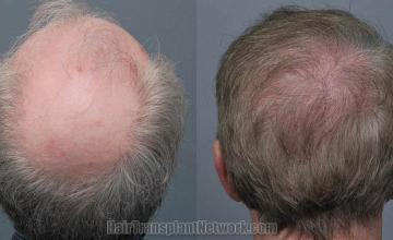 Back view before and after hair transplantation photos