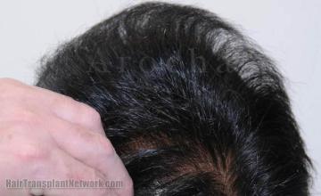 Hair transplantation surgery before and after pictures