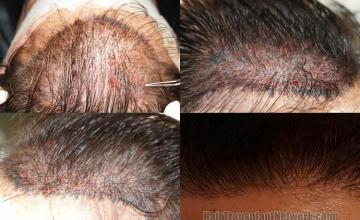 Hair restoration procedure before and after pictures