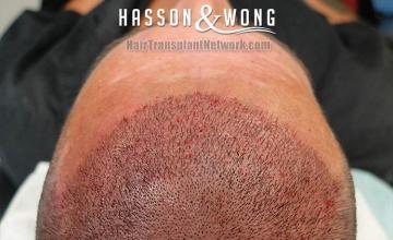 Hair restoration procedure before and after pictures