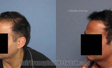 Hair restoration procedure results