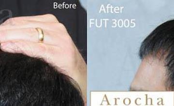 Hair transplantation surgery before and after images