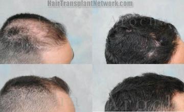 Right view before and after hair restoration procedure