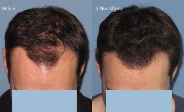 Hair transplantation surgery before and after images