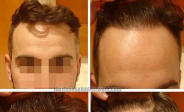 Hair transplantation surgery after photos