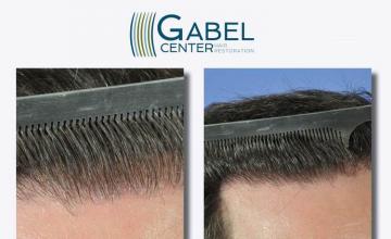 Hair transplant surgery before and after photos