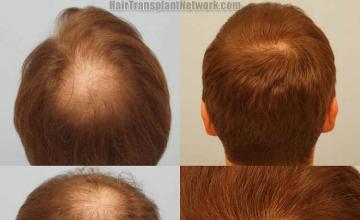 Hair transplantation surgery before and after images