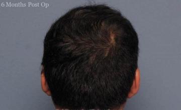 Hair restoration surgery before and after photos