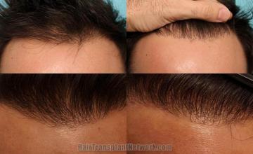 Hair restoration procedure before and after results