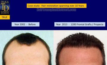 Hair restoration procedure before and after results