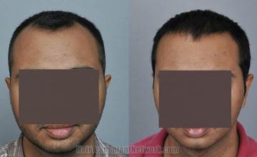 Hair restoration procedure before and after results