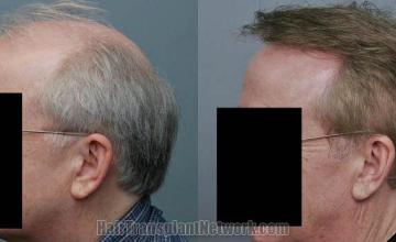 Hair transplantation surgery before and after images