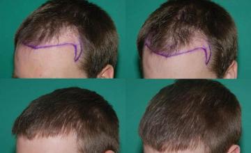 Hair transplantation surgery before and after images