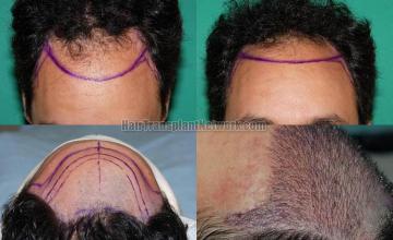 Hair restoration procedure before and after pictures