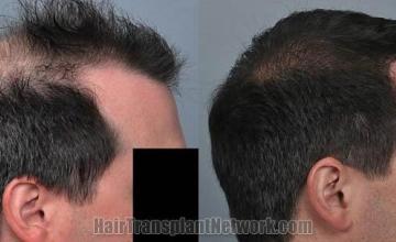 Hair transplantation surgery before and after images