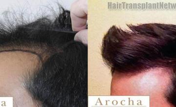 Hair transplantation surgery before and after photos