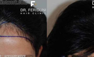 Top view before and after hair restoration results