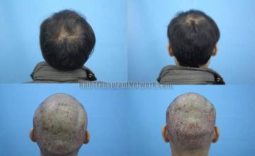 Hair replacement surgery before and after images