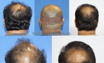 Hair replacement surgery before and after images