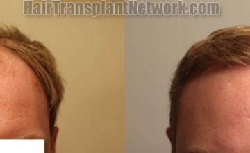 Front view - Before and after hair restoration procedure