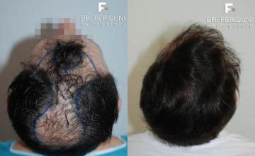 Surgical hair transplantation result photographs