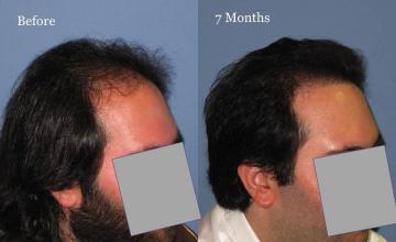 Hair transplantation surgery before and after photos