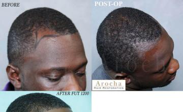 Hair transplantation surgery before and after photos