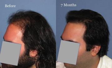 Hair transplantation surgery before and after photos