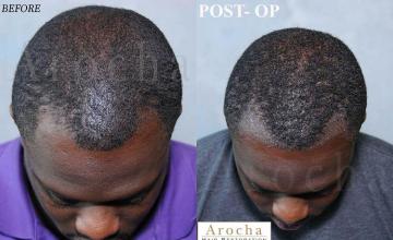 Hair restoration procedure before and after results