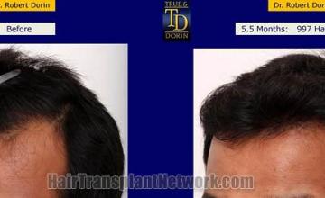 Hair transplantation surgery before and after pictures