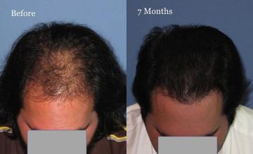 Hair restoration surgery before and after photos