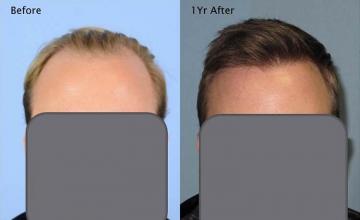 Hair restoration procedure before and after results