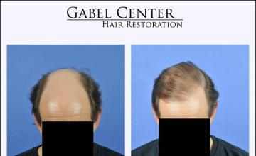 Hair restoration procedure before and after pictures