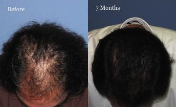 Hair restoration procedure before and after results