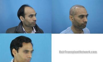 Hair restoration procedure after result images