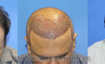 Hair transplantation surgery before and after images