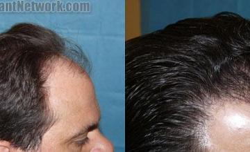 Hair transplant before and after result photos