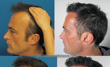 Hair restoration procedure before and after pictures